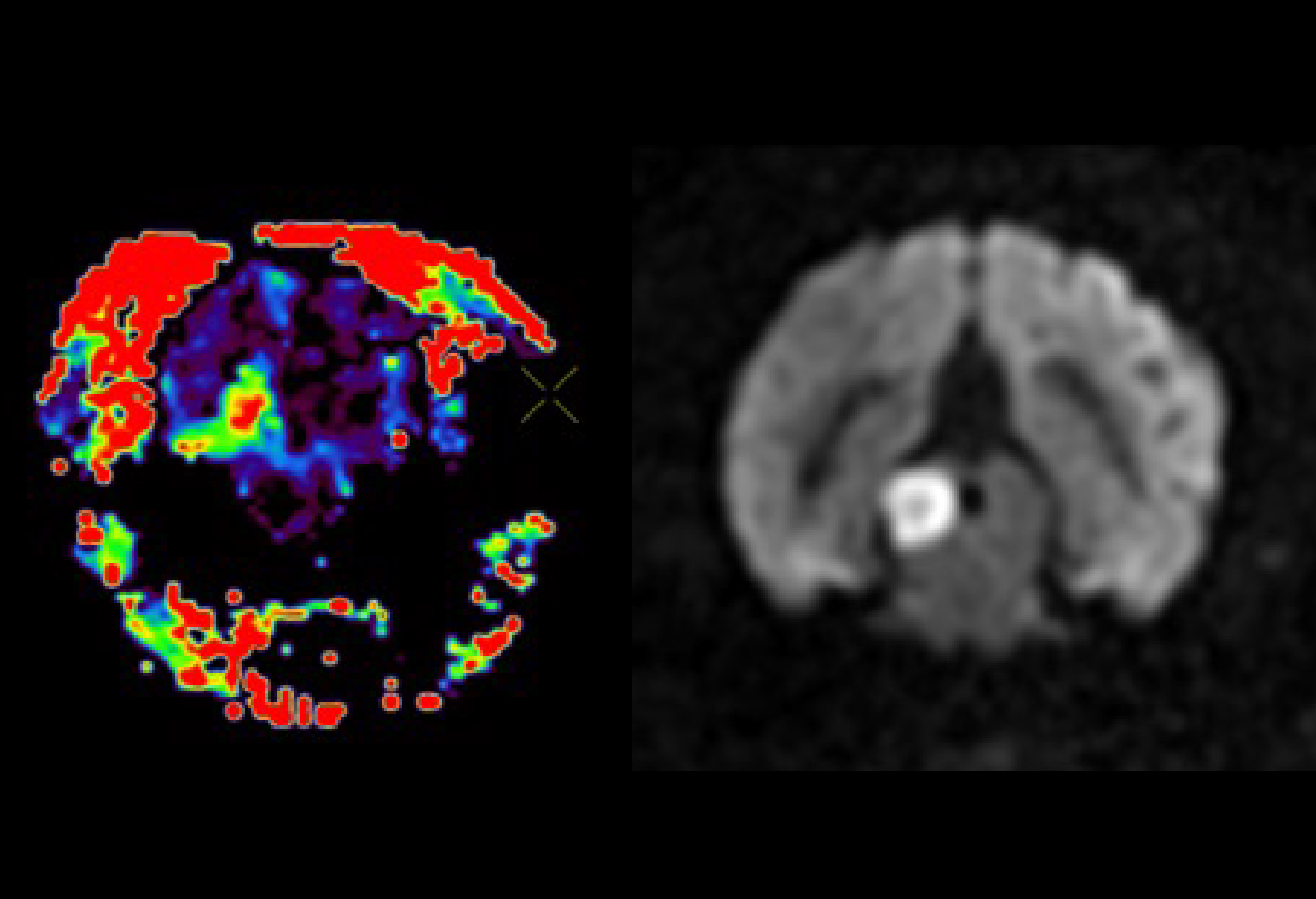 Perfusion MRI