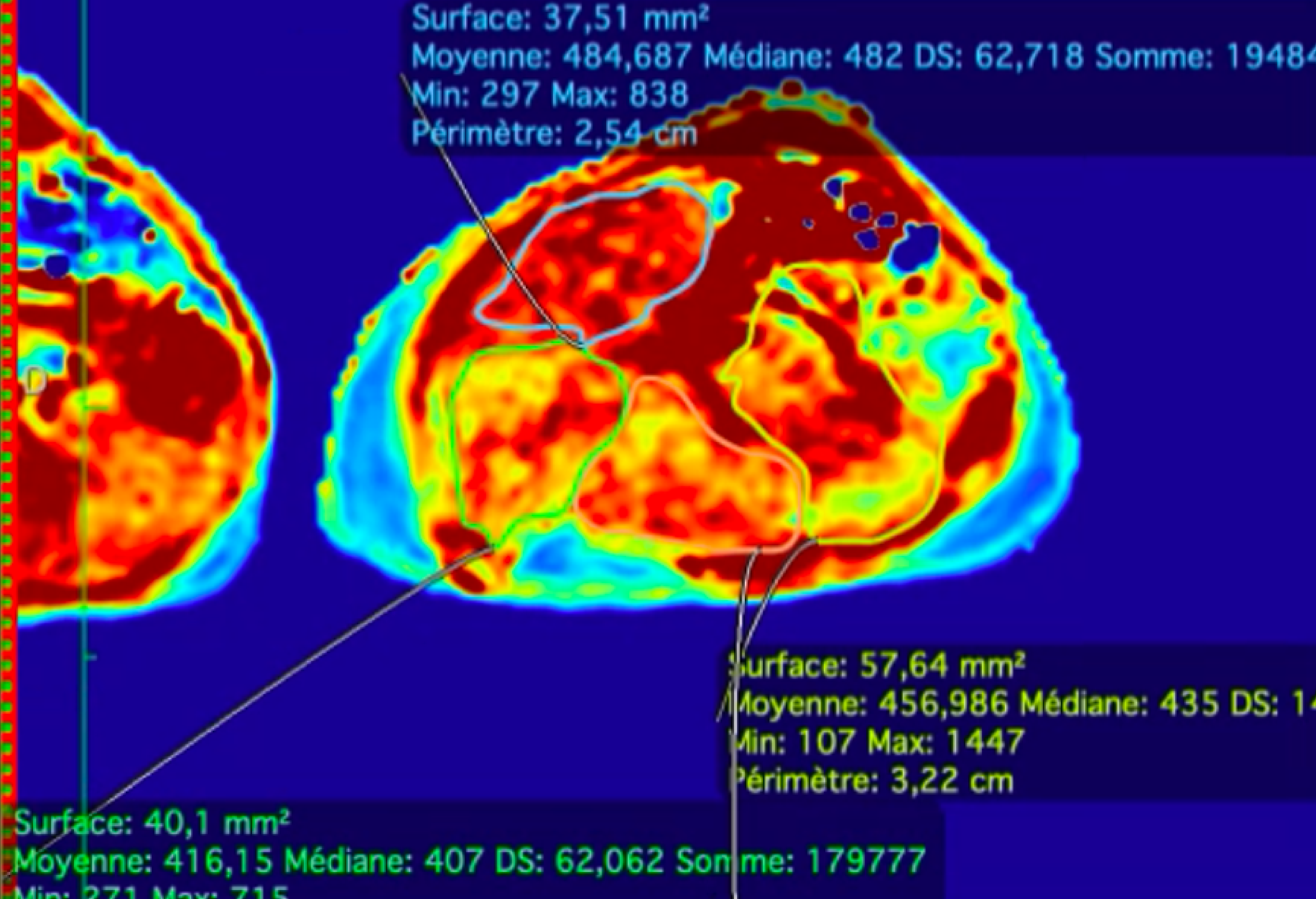 Mobile MRI